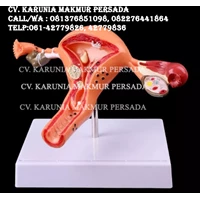 Alat Peraga Pendidikan Model Anatomi Uterus And Ovaries Normal and Pathological